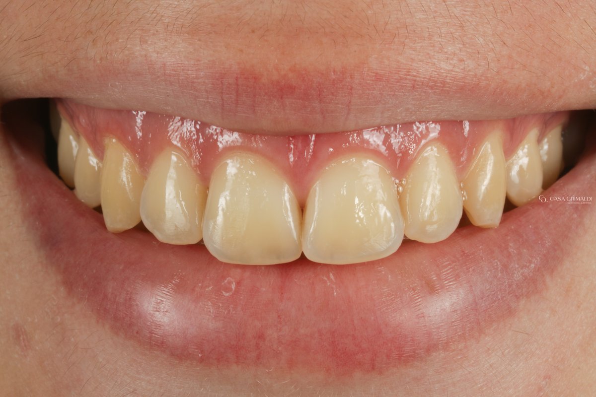 Clareamento dental em Itapema — antes do tratamento