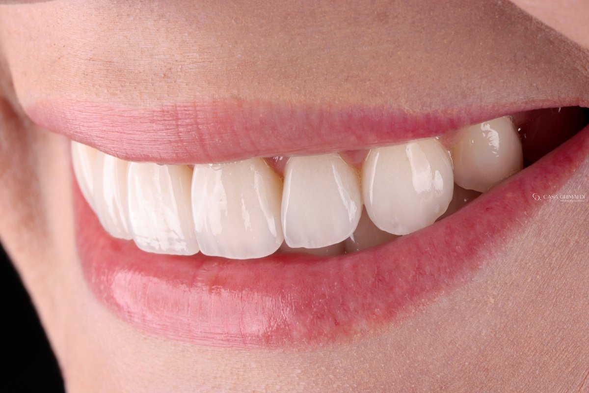 Sorriso após o tratamento com facetas dentárias em cerâmica