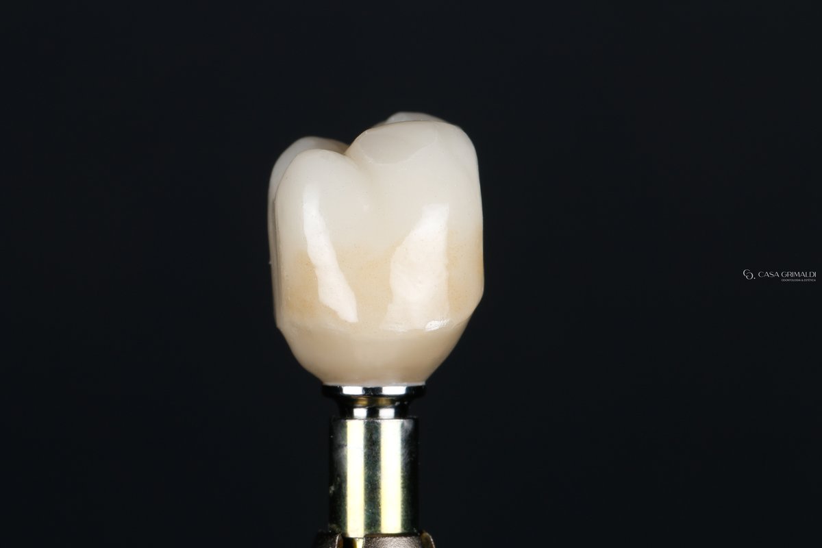 Implante dentário em Itapema — coroa cerâmica sobre pilar protético