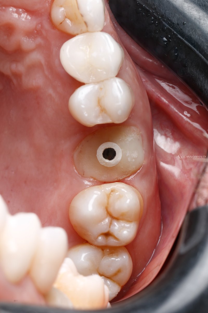 Implante dentário — fase intermediária com cicatrizador