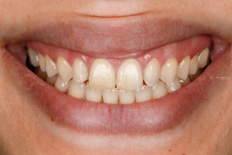 Antes do tratamento — sorriso natural do paciente