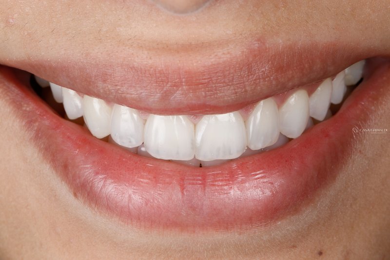 Resultado final de restauração estética em resina
