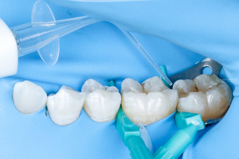 Etapa 3 — técnica aplicada em cárie interproximal