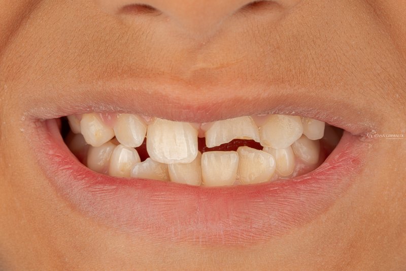 Odontopediatria em Itapema — fratura dental antes do tratamento