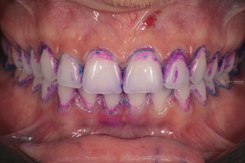 Revelador bicolor de placa bacteriana — diagnóstico em profilaxia dental