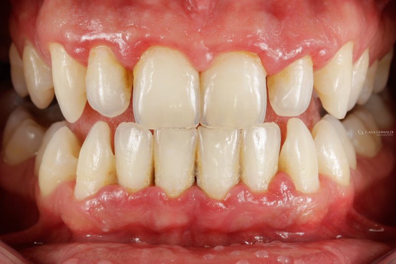 Profilaxia dental em Itapema — antes do tratamento