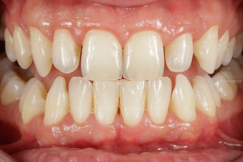 Profilaxia dental em Itapema — 45 dias após o tratamento