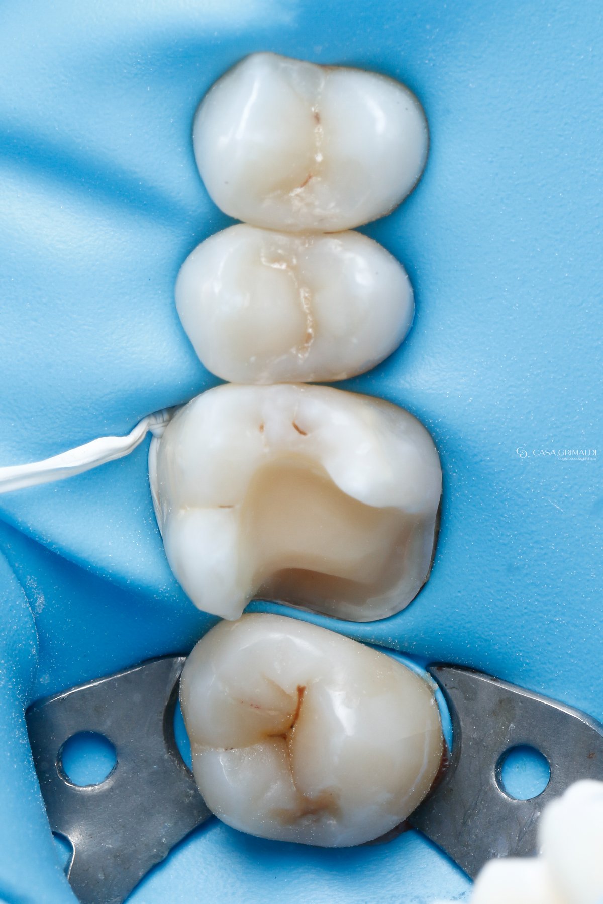 Restauração cerâmica em Itapema — molar com cárie extensa antes do tratamento