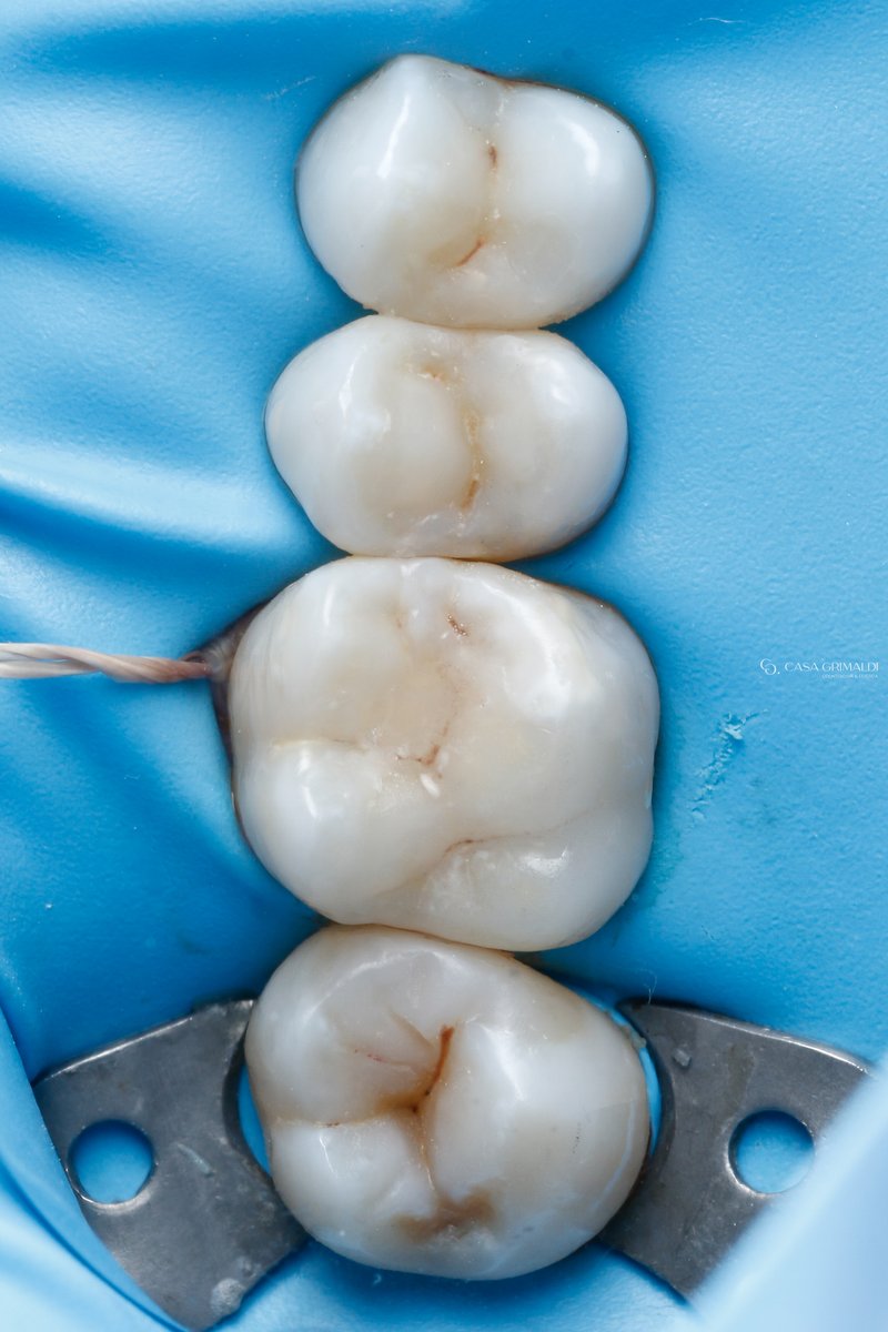 Restauração cerâmica em Itapema — molar com restauração cerâmica integrada após o tratamento